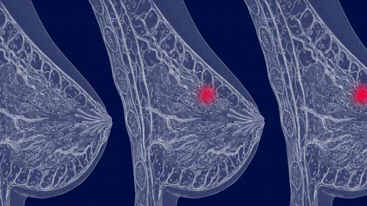 Лечение рака груди в немецких клиниках