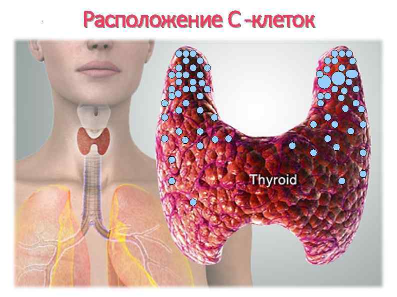 Лечение рака щитовидной железы в германии