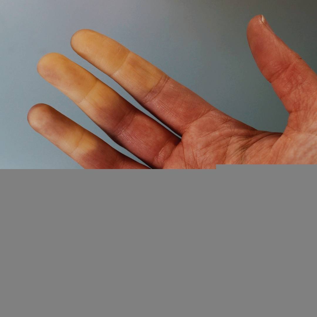 Феномен рейно: почему белеют пальцы